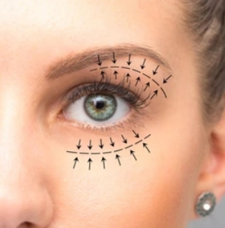 Agendamento de Cirurgia de Olhos a Laser Miopia Mogi Mirim - Cirurgia Retirada Bolsa Olhos