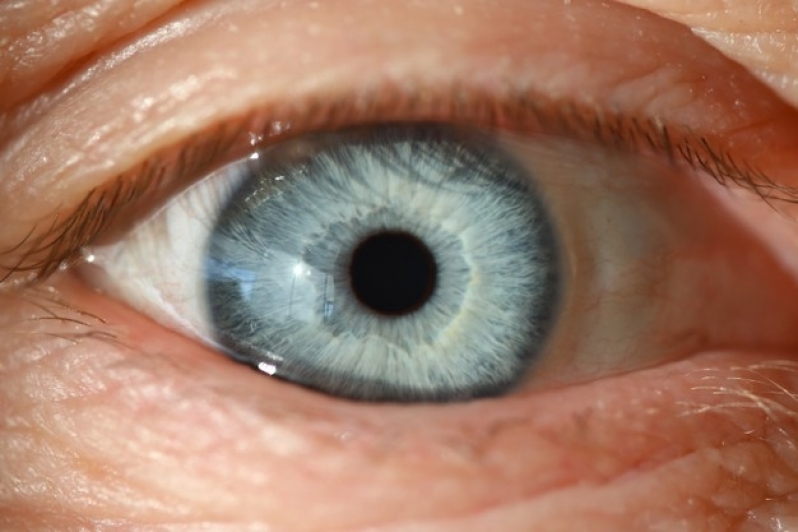 Cirurgia de Catarata e Glaucoma Caierias - Cirurgia no Olho Catarata
