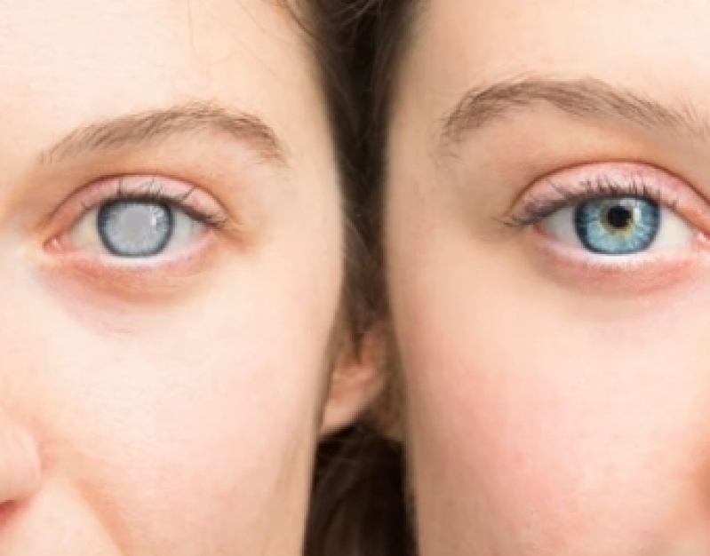 Cirurgia de Catarata no Olho Imirim - Cirurgia de Catarata com Lente