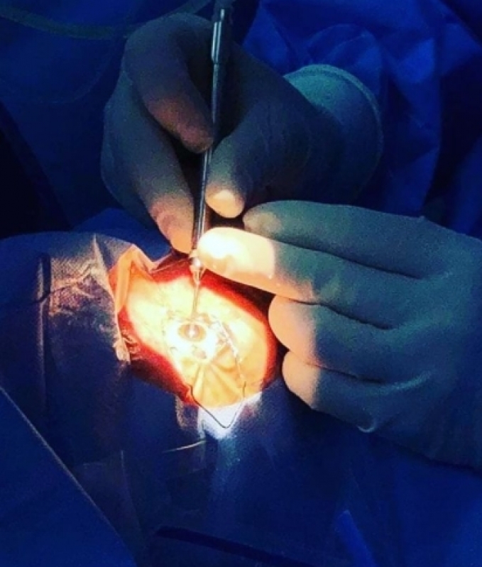 Clínica de Cirurgia de Glaucoma Avançado São Bernardo Centro - Cirurgia de Glaucoma com Implante de Válvula