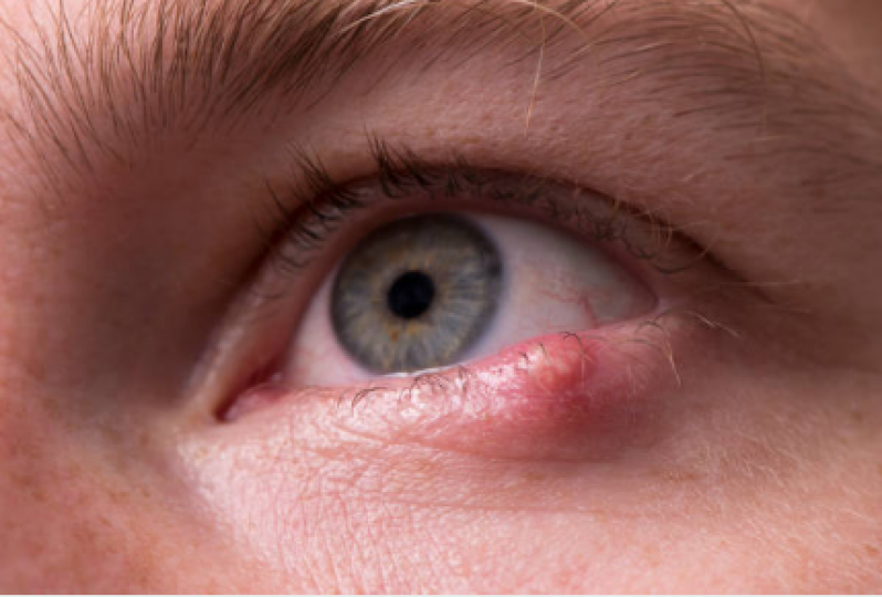 Clínica para Tratamento de Calázio no Olho Osvaldo Cruz - Olho Inchado Tratamento
