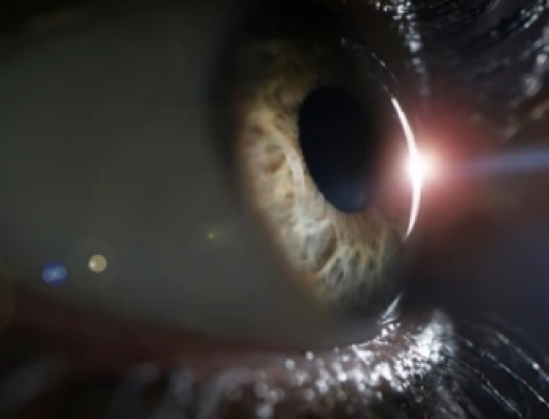 Olho Seco Tratamento Clínicas Alphaville Industrial - Tratamento para Olho Injeção Anti Vegf