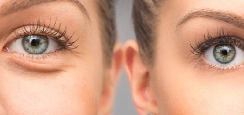 Onde Fazer Cirurgia de Olhos a Laser Miopia Higienópolis - Cirurgia Retirada Bolsa Olhos
