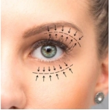agendamento de cirurgia de olhos a laser miopia Lençóis Paulista