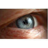 Cirurgia no Olho Catarata