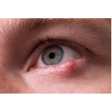 clínica para tratamento de calázio no olho Bom Retiro