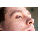 tratamento de calázio no olho clínicas Itapira