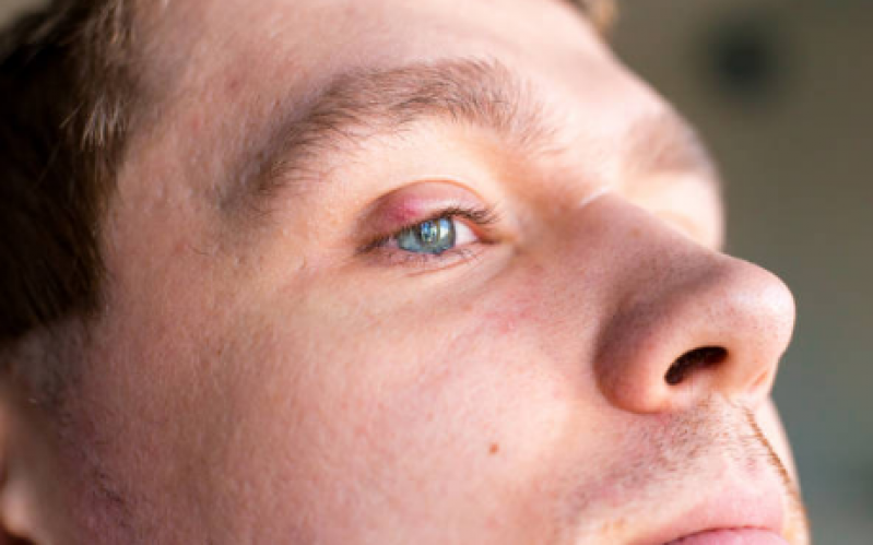Tratamento de Calázio no Olho Clínicas Santa Efigênia - Tratamento de Calázio no Olho