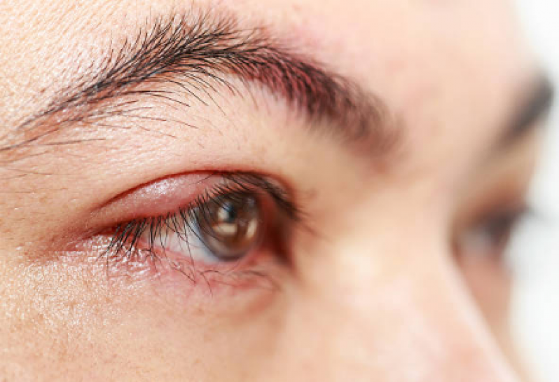 Tratamento de Calázio no Olho Santo André - Olho Inchado Tratamento