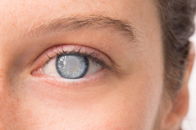 Tratamento para Catarata no Olho Agendar Caierias - Tratamento Clínico Catarata